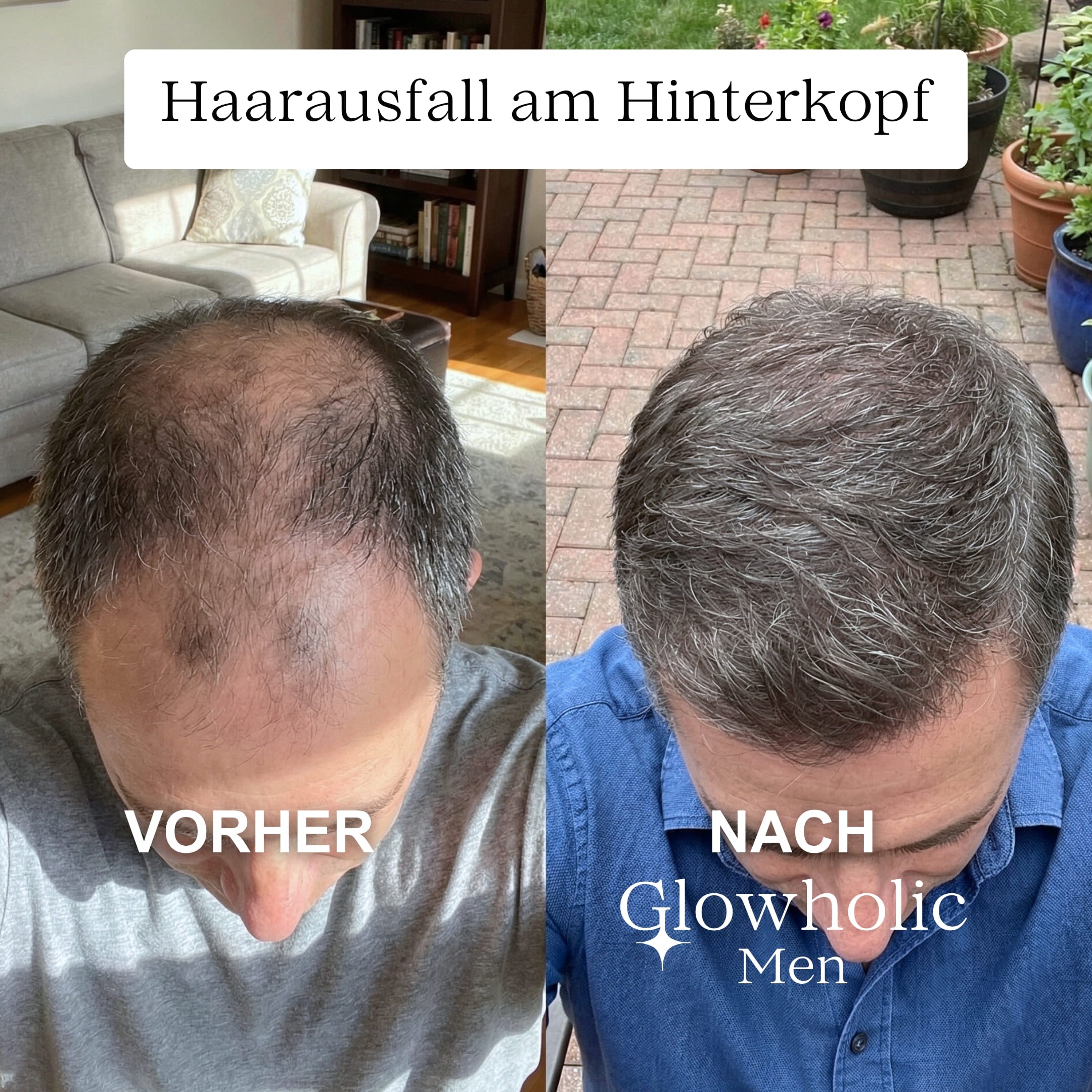 Glowholic Men - Anti-Haarausfall Starter Set - Micro-Needling Infusion für zuhause