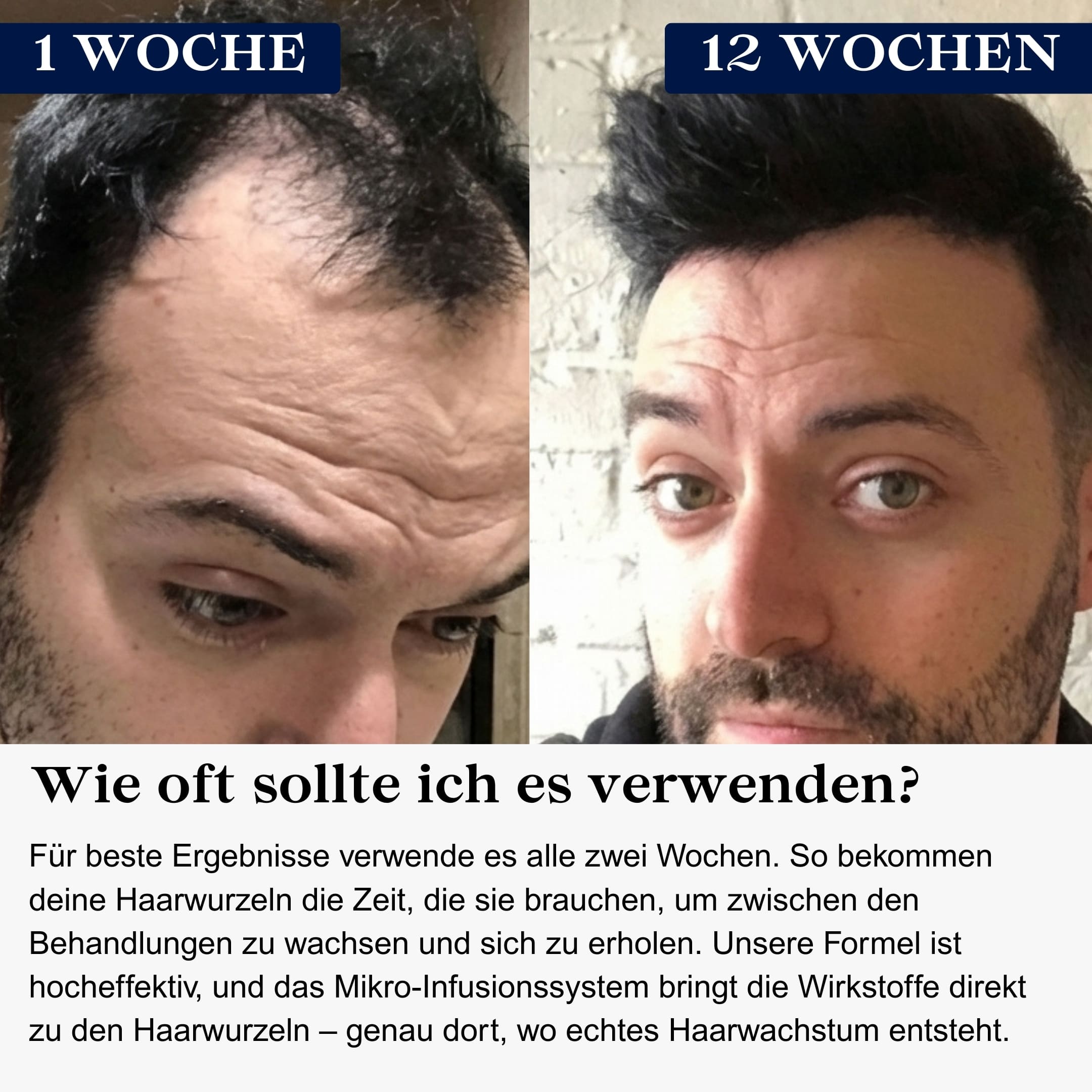 Glowholic Men - Anti-Haarausfall Starter Set - Micro-Needling Infusion für zuhause
