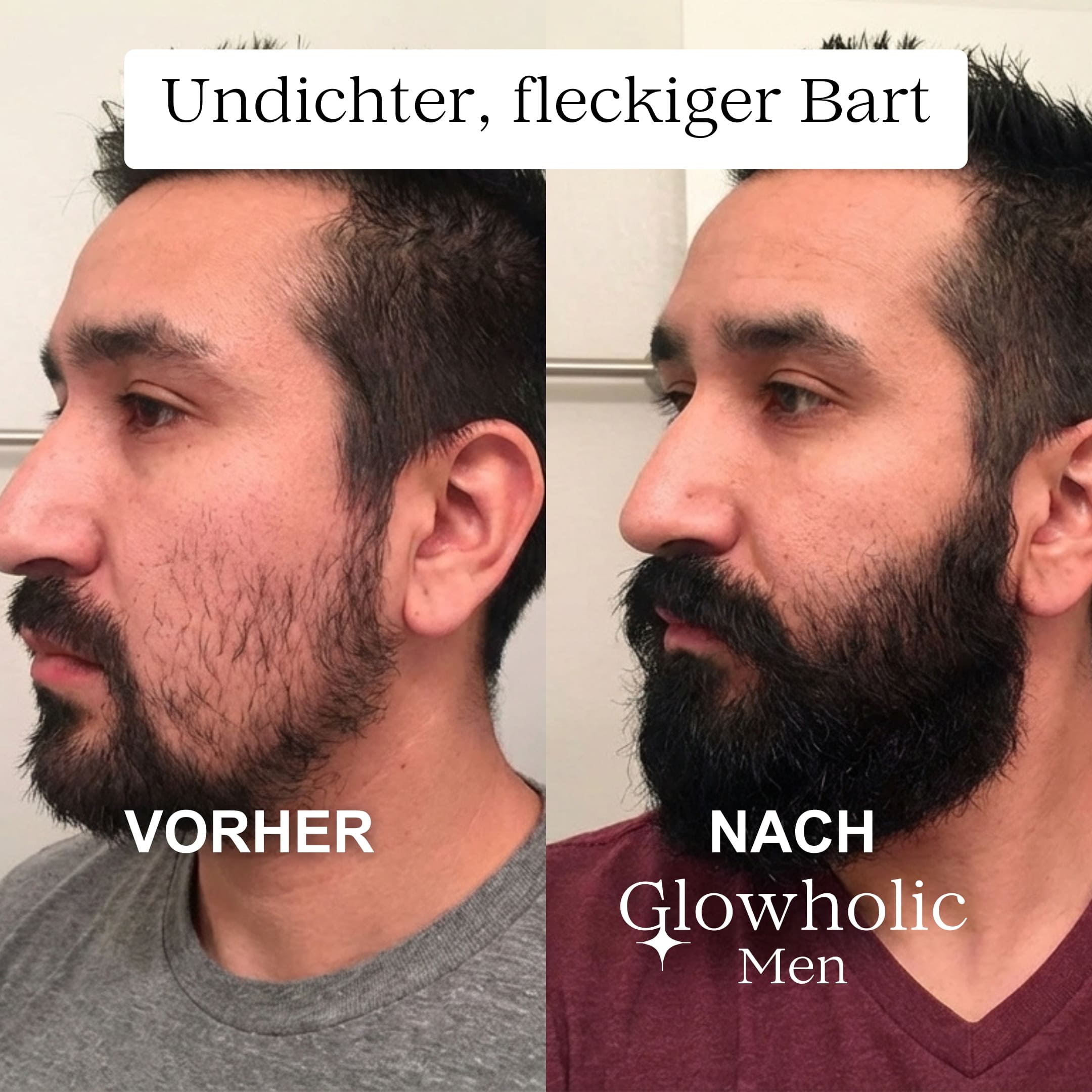 Glowholic Men - Anti-Haarausfall Starter Set - Micro-Needling Infusion für zuhause